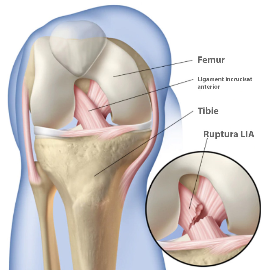 Ligament incrucisat anterior / Ruptura LIA